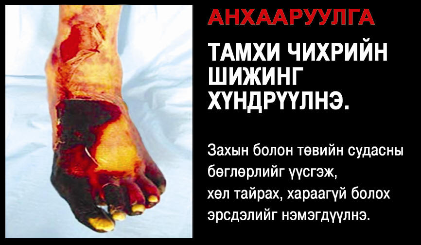 Mongolia 2010 Health Effects vascular system - diseased organ, leg, gross